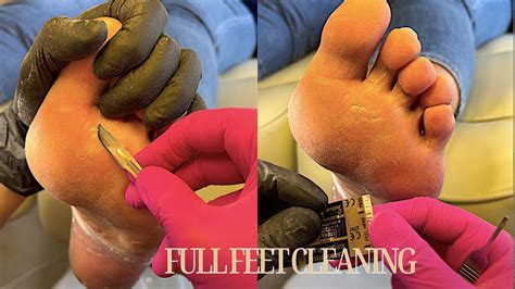 Pedicure 👣 Pamper Your Feet Cleaning With A Surgical Scalpel Youtube