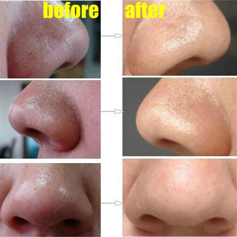 How To Easily Remove Deep Blackheads Alldaychic