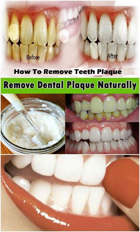 Check spelling or type a new query. REMOVES PLAQUE AND WHITEN YOUR TEETH IN 15 MIN WITH THIS ...