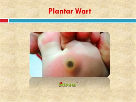 PPT Plantar Wart Causes Symptoms Daignosis Prevention And