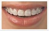 Prices For Braces Images