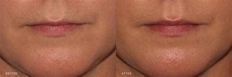 Botox Lip Flips Before And After Photos Rejuva Center