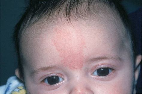 Newborn Facial Lesions Visual Diagnosis And Treatment In Pediatrics