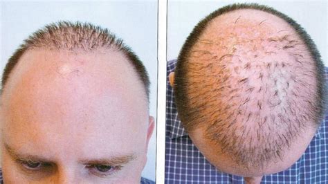 Best hair transplant images 2024 - FUE, FUT, Receding hairline, Norwood