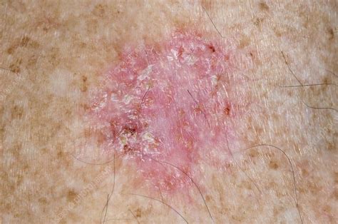 Squamous Cell Cancer On The Shoulder Stock Image C0130952