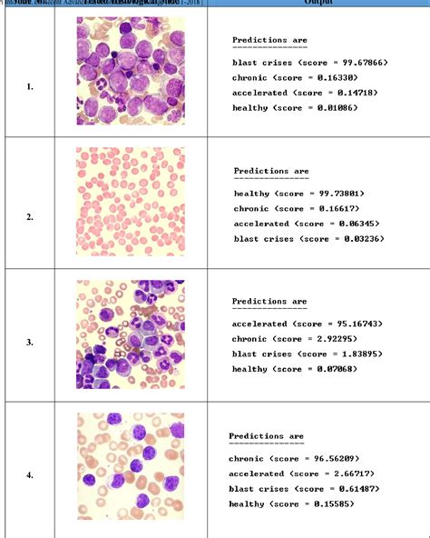 Phase Classification Of Chronic Myeloid Leukemia Using Convolution