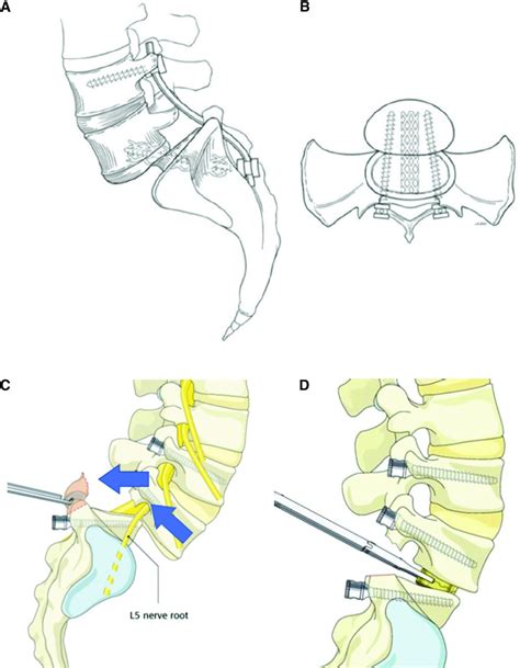 Spondylolysis And Isthmic Spondylolisthesis A Guide To Diagnosis And