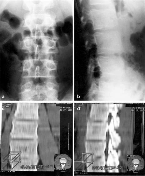 Ad Case 2 A Ap And B Lateral Radiographs Of The Lumbar Spine Reveal