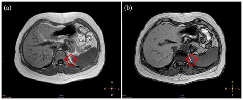 A Cortisol Secreting Adrenal Adenoma Combined With A Micro