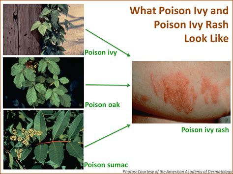 How To Prevent Poison Ivy Rash A Springtime Curse Skincare Physicians