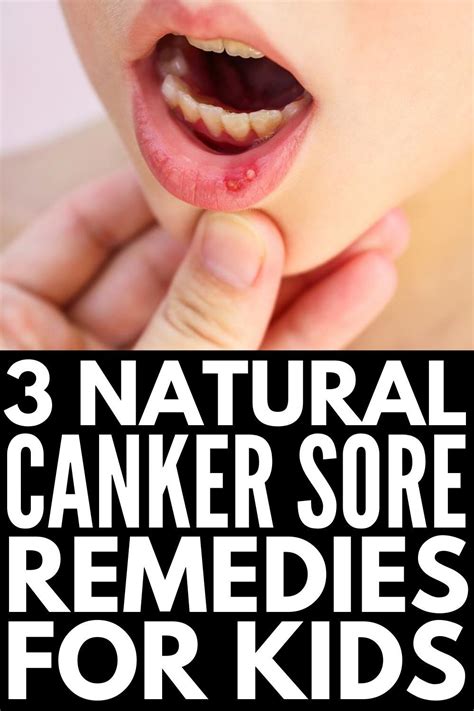 Natural And Effective 9 Canker Sore Remedies That Work Fast Canker