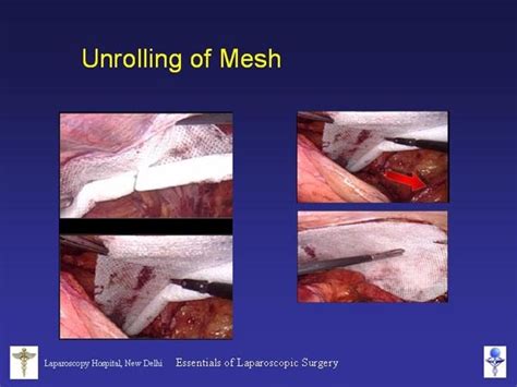 Mesh Placement In Laparoscopic Repair Of Inguinal Hernia Robotic