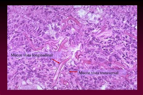 Mbarek c, zribi s, khamassi k, et al. PPT - MUCORMICOSIS PowerPoint Presentation, free download ...