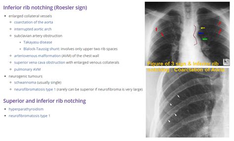 Inferior Rib Notching Causes Note Figure Of 3 Sign And Inferior Rib