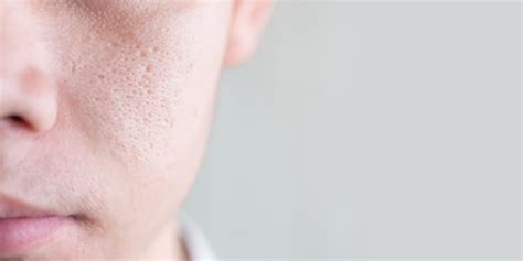 Open Pores On Face Causes Treatment Cost And Prevention Tips