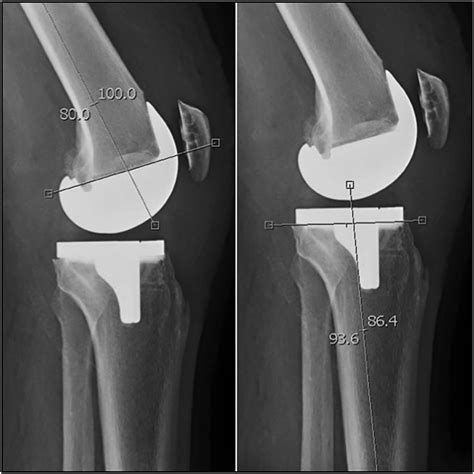 Effect Of Obesity On Component Alignment In Total Knee Arthroplasty