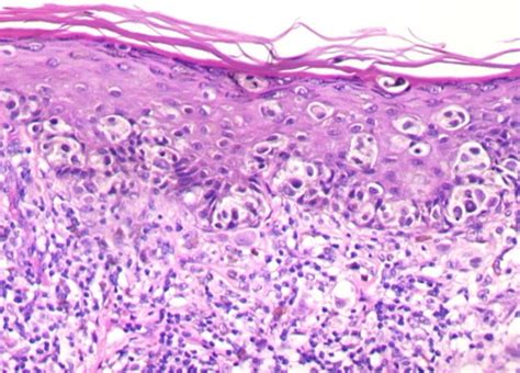 Histology Showing Superficial Spreading Component Of Malignant Melanoma