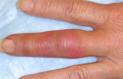 What Is Causing This Womans Swollen Red And Tingling Finger