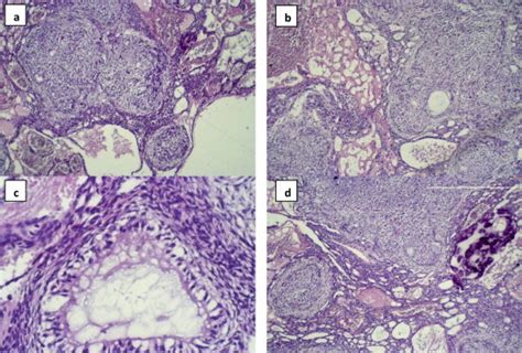 Histopathological Staining Of Adenomatoid Odontogenic Tumor Aot