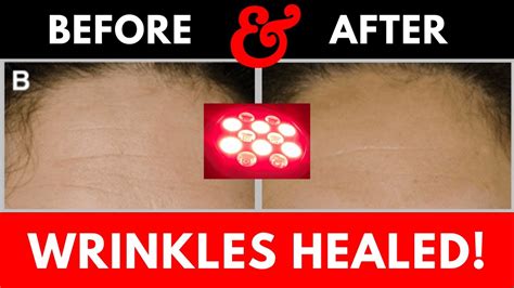 Red Light Therapy Wrinkle Treatment Before And After Youtube