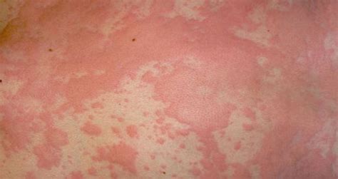 25 Extremely Bizarre Medical Disorders Urticaria Fungal Rash Plaque