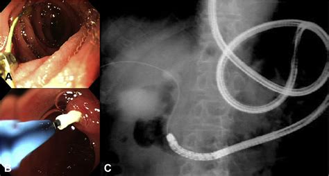 Balloon Enteroscopyassisted Ercp In Patients With Roux En Y
