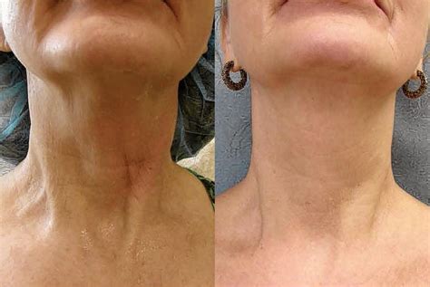 Radio Frequency Skin Tightening Expressions Cosmetics