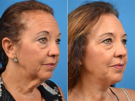 patient 122406460 laser assisted weekend neck lift before and after photos clevens face and