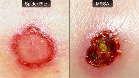 How To Cure A Mrsa Infection Naturally What Is Mrsa Infection And Its