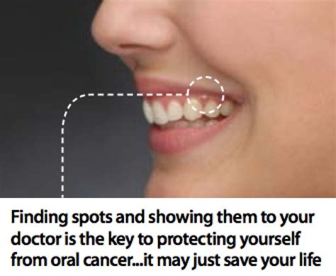 Its Oral Cancer Awareness Month Have You Looked In Your Mouth Lately