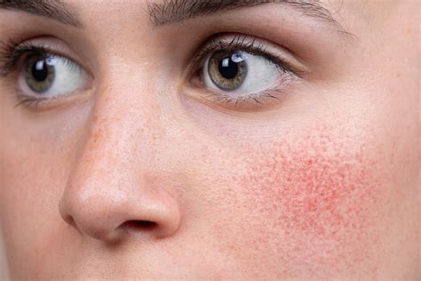 Rosacea Awareness Month What Aesthetic Treatments Help Rosacea