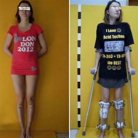 Aspiring Model Gets Leg Surgery To Increase Her Height To Industry