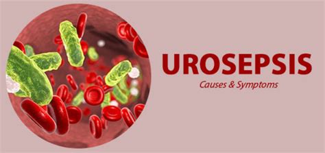 A Brief Insight Into Urosepsis Its Causes And Symptoms