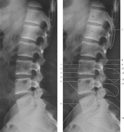 The lumbar spine lateral view images the lumbar spine which generally consists of five vertebrae (see: Spine | Radiology Key