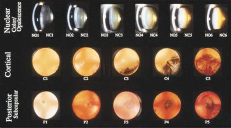 Grading In Ophthalmology Eye Health Nepal
