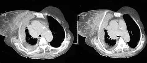 Breast Cancer Invading Chest Wall Radrounds Radiology Network