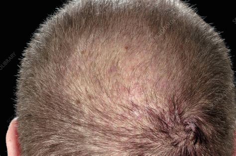 Folliculitis Of The Scalp Stock Image C025 8048 Science Photo Library