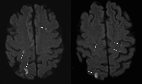 Transient Ischemic Attack Definition Diagnosis And Risk