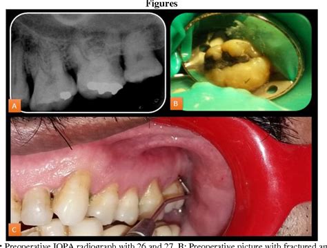 Figure 1 From Endodontic Management Of Four Rooted Maxillary Second