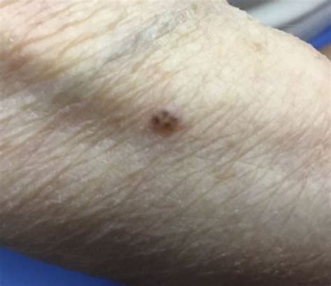 Dermdx Speckled Papule On The Arm Dermatology Advisor