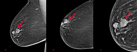 Cureus Mammographic And Sonographic Findings Of Intraductal Papilloma