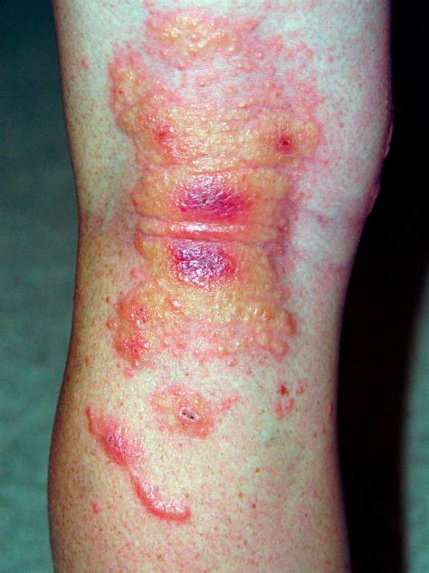 Poison Ivy Rashes And Blisters Gallery Ebaums World