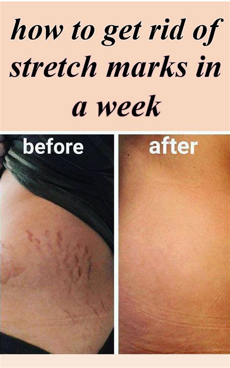 Pin On Stretch Marks
