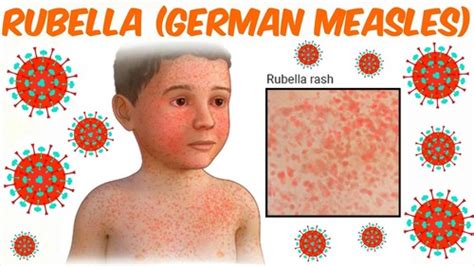 Children`s Infectious Rash Disease Rubella Varicella Measles 5th
