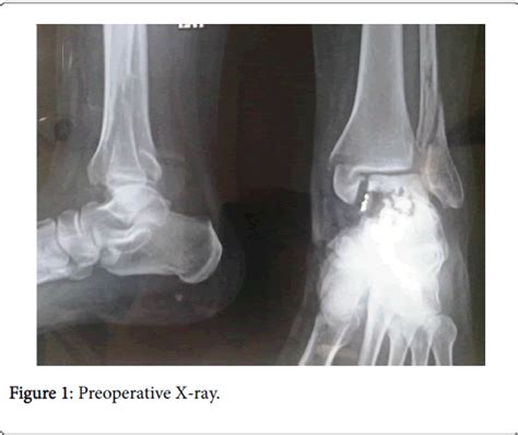 Clinical Research Foot Ankle Preoperative