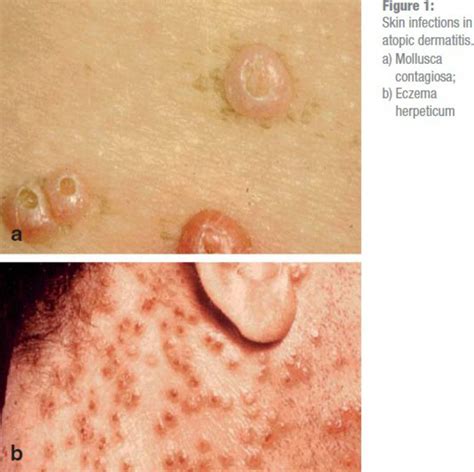 The Diagnosis And Graded Therapy Of Atopic Dermatitis 21072014