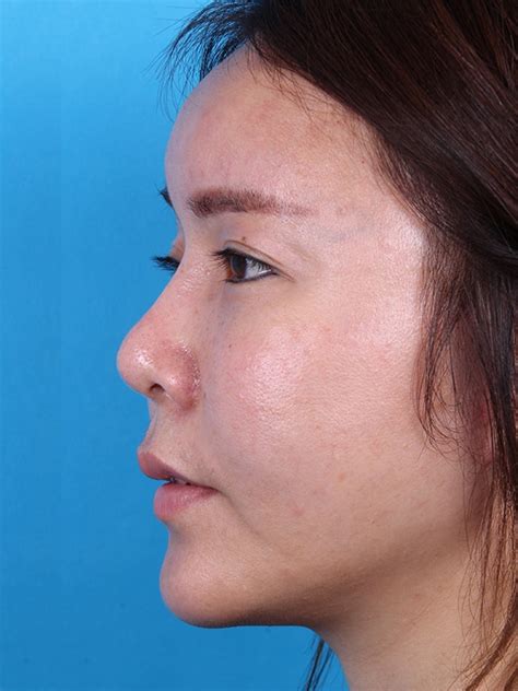Forehead Augmentation Archives Vip Plastic Surgery