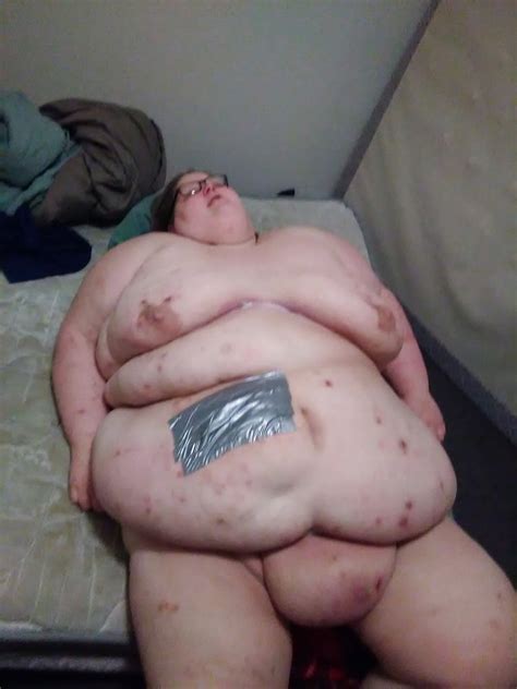 Ssbbw Reality Discolored Skin Scars Bedsores Acne Pics Xhamster