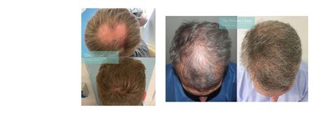 Aggregate More Than Crown Hair Transplant Latest Dedaotaonec