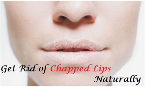 How To Get Rid Of Chapped Lips Naturally